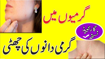 Garmi Dano Ka Ilaj Prickly Heat Treatment