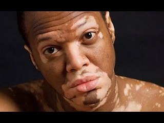 Causas y solución del vitiligo / Causes and solution of vitiligo
