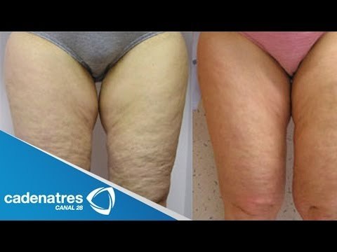 ¿Cómo quitar la celulitis? / ¡AÚN PUEDES ELIMINAR LA CELULITIS! / How to remove cellulite?