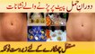 Remove Pregnancy Stretch Marks Home Remedies - Get Rid of Stretch Marks Permanently Urdu Hindi