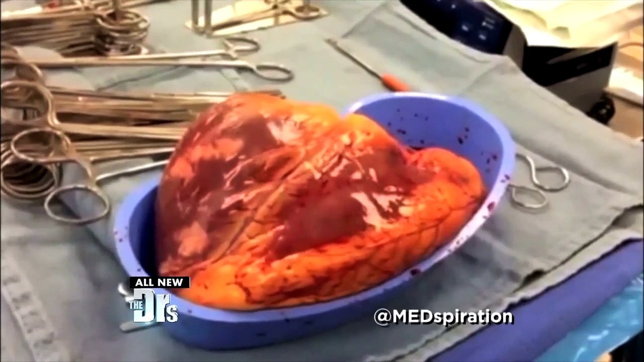 Le cœur d'un cocaïnomane bat 25 minutes hors de son corps