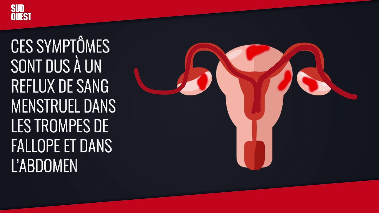 Qu'est-ce que l'endométriose ?