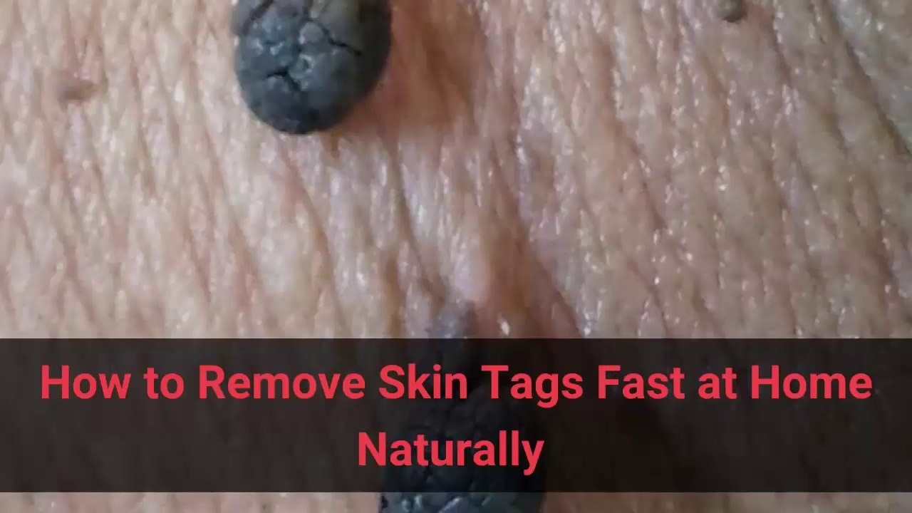 How to Remove Skin Tags Fast at Home Naturally