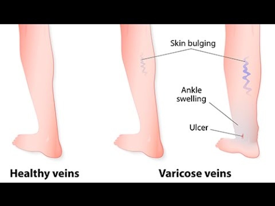 Qu’est-ce qu’une varice interne ?