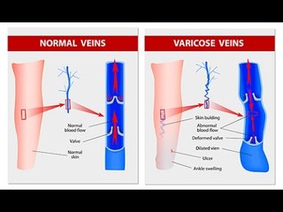 Quels sont les symptômes des varices ?
