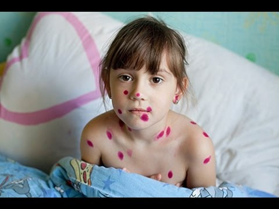 Comment soigner l'urticaire chez l'enfant?