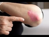 Comment reconnaître une poussée d'eczéma?