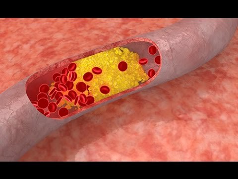 Quels sont les différents types de maladies cardiovasculaires ?