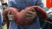 Constipation: Surgeons remove 30 inches of man’s constipated intestinal tract