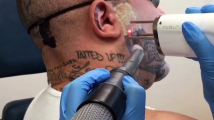 Tattoo Removal All You Need To Know