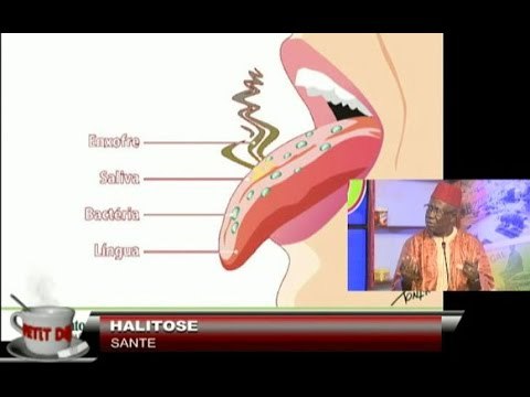 Petit Dej (07 avr.-17) - Medecine Traditionelle : Halitose ou Mauvaise haleine - Causes et solutions