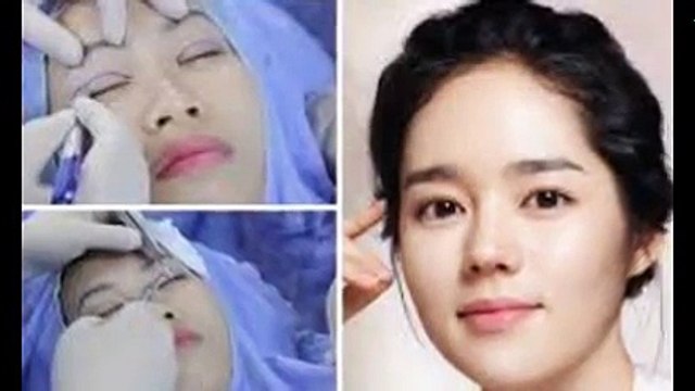 Nhấn mí Hàn Quốc khắc phục hoàn toàn những khuyết điểm của mắt