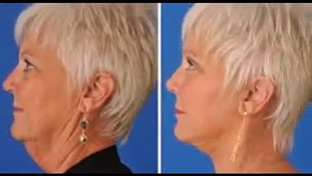 Căng da mặt nội soi hiệu quả tại Viện thẩm mỹ Hà Nội