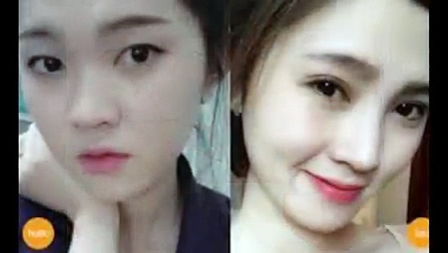 Nhấn mí Hàn Quốc dịch vụ thẩm mỹ không cần phẫu thuật