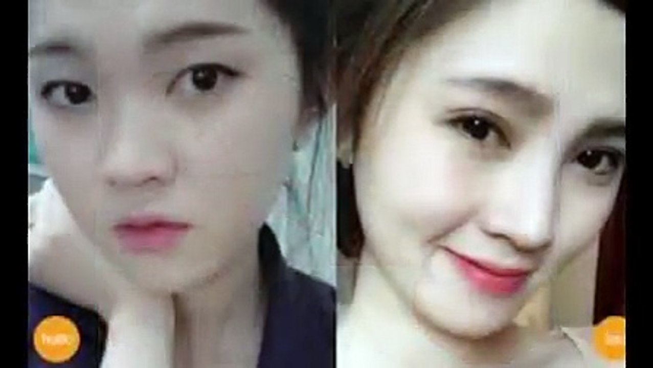 Nhấn mí Hàn Quốc dịch vụ thẩm mỹ không cần phẫu thuật