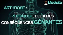 Pourquoi l'arthrose peut-elle avoir des conséquences graves ?