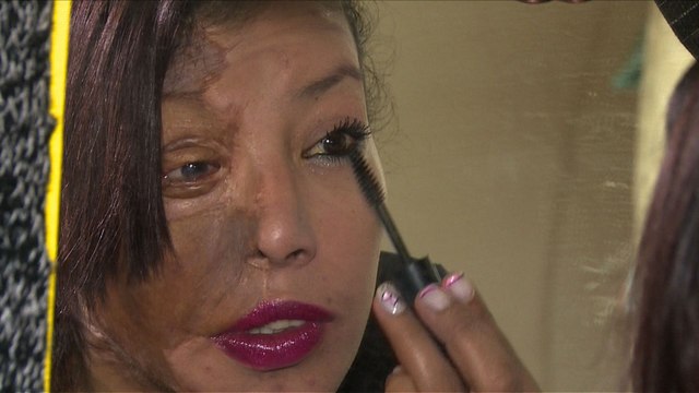 Un chirurgien opère les femmes défigurées par l'acide