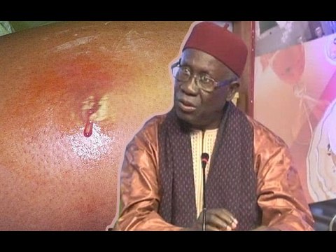 Petit Dej (17 fev.-17) - Médecine traditionnelle: Causes et traitements des Abcès