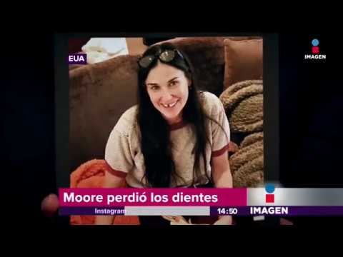 Demi Moore perdió dos dientes | Imagen Noticias con Yuriria Sierra