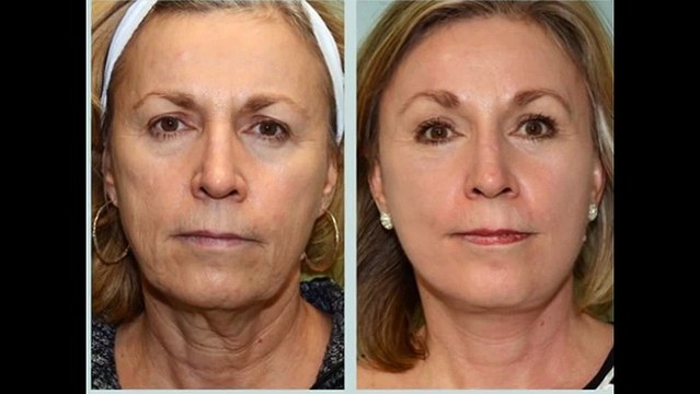 căng da mặt hết bao nhiêu tiền - TS.BS. Mai Mạnh Tuấn