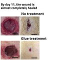 30.Wound-healing glue could prevent scars