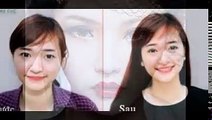 Nhấn mí Hàn Quốc cải thiện những khuyết điểm của đôi mắt