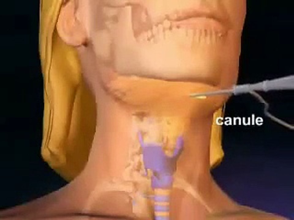 Liposuccion Tunisie : mode opératoire pour extraire la graisse du cou et du ventre