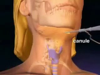 Liposuccion Tunisie : mode opératoire pour extraire la graisse du cou et du ventre