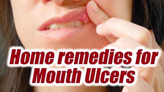 Mouth Ulcer, Home Remedies to treat them; Check out here