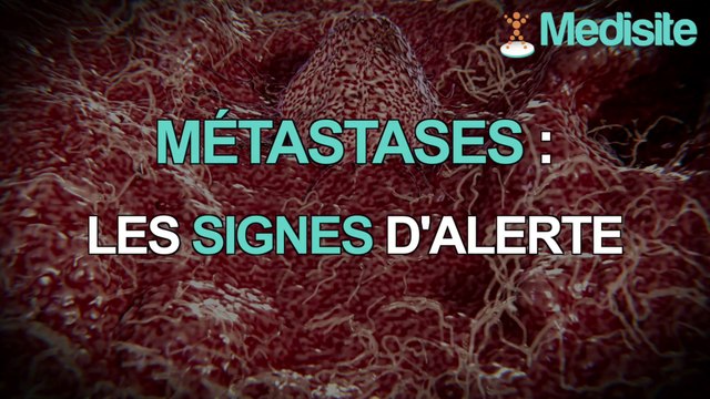 Métastases : les signes qui ne trompent pas