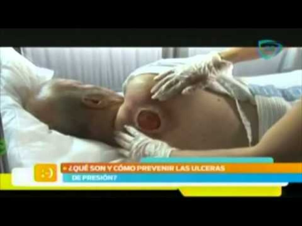 Salvando vidas: Cómo prevenir las úlceras en la piel