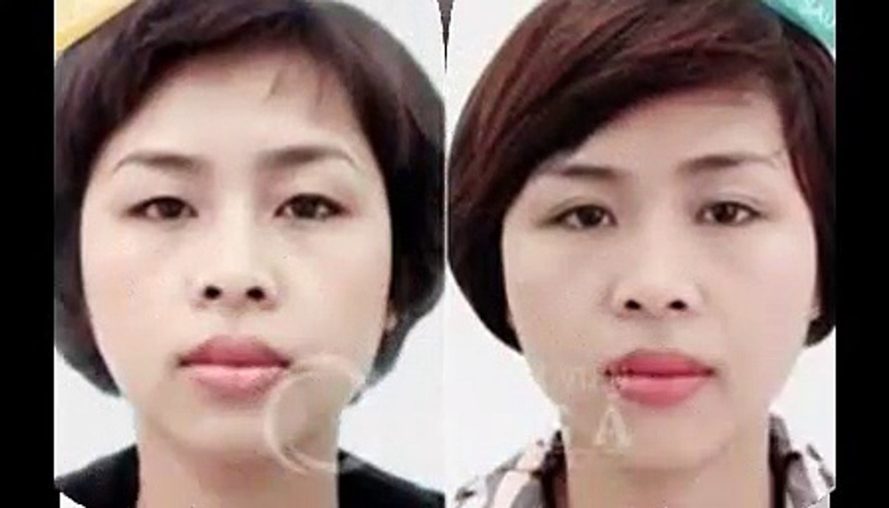 Nhấn mí Hàn Quốc tạo hình mắt hai mí đẹp tự nhiên
