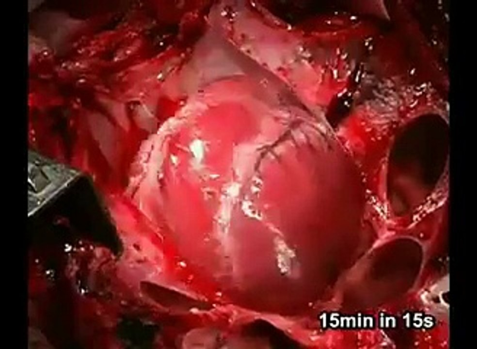 FIBRILACIÓN VENTRICULAR