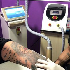 adapazar dövme silme