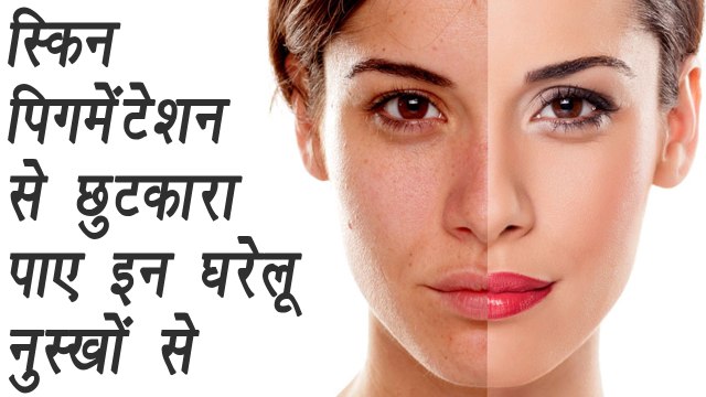 Skin Pigmentation: 10 Must-Try Natural Remedies, पिगमेंटेशन से छुटकारा पाए घरेलू नुस्खों से | Boldsky