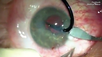 I hiqet grepi i cili i ishte ngulur sy, kujdes pamje të rënda