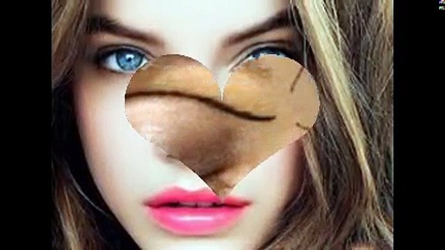 Nhấn mí Hàn Quốc dịch vụ thẩm mỹ không cần phẫu thuật