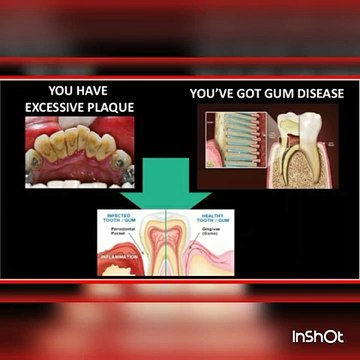 How to Keep Teeth & Gums Healthy Home remedies for tooth decay and cavities