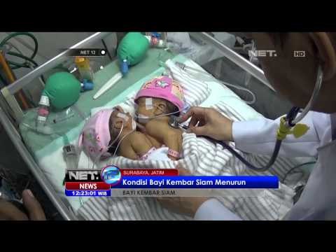 Kondisi Bayi Kembar Siam di Surabaya Semakin Menurun - NET12