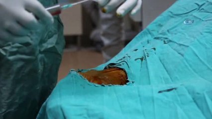 Kolundan Uygulanan Anjiyo ile Sağlığına Kavuştu