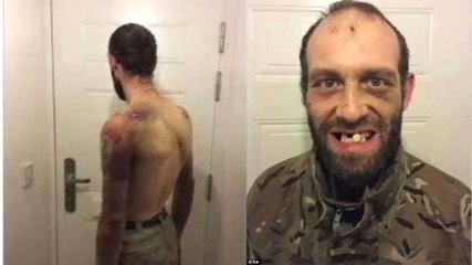 Akılalmaz İşkence: Dişlerini Çekiçle Kırıp Kestikleri Cinsel Organını Yedirmişler