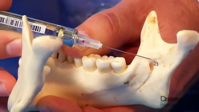 Mandibular Anesthesia Injection Techniques _ DENTSPLY Pharmaceutical