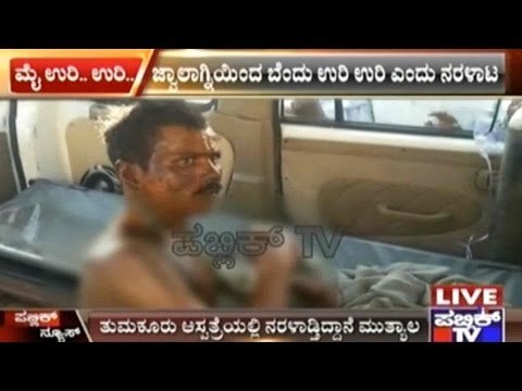 Tumkur: Man Runs Out Of Hospital Unable To Bear Inflammation Of Burn Wounds