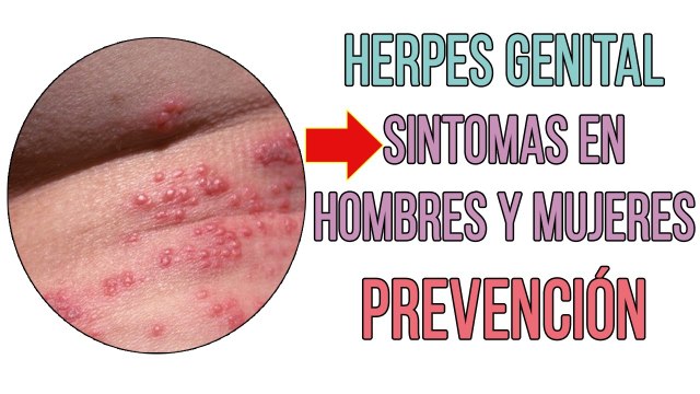 HERPES GENITAL SINTOMAS EN HOMBRES Y MUJERES ¿COMO PREVENIR EL SIGUIENTE BROTE