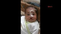 Dudak ve Burnu Eksik Doğan 2 Yaşındaki Ege Umut'a 5'inci Ameliyat