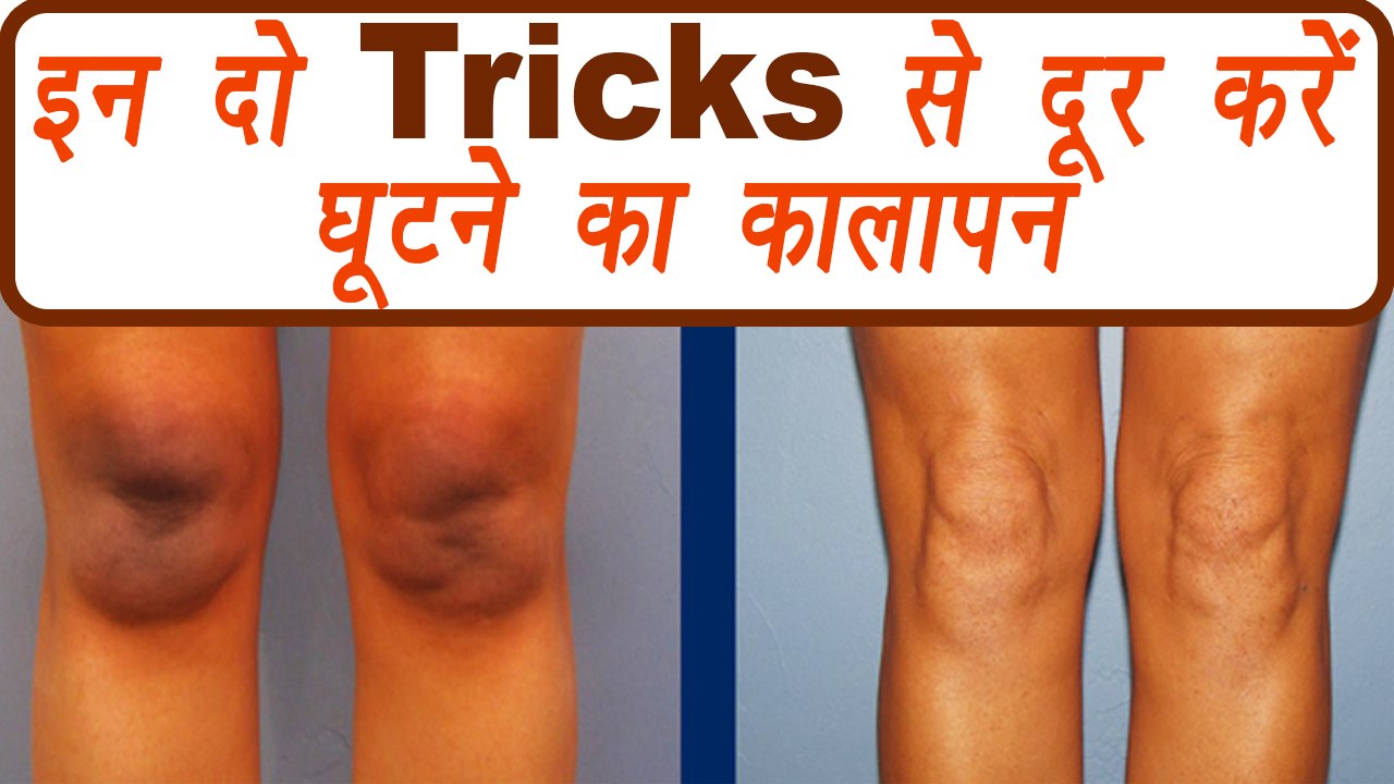 Knees Blackness removal DIY pack | घूटने का काल...