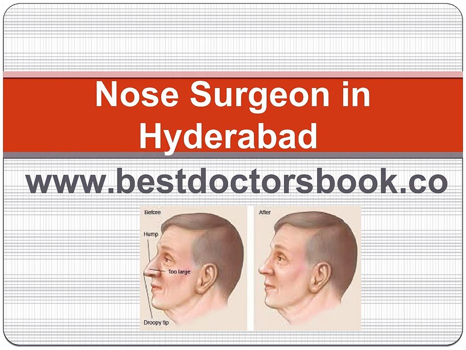 Nose Surgeon in Hyderabad |Rhinoplasty in Hyderabad