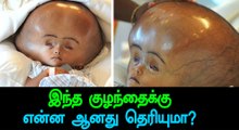 'Giant Head' Baby Roona Begum passed away-Oneindia Tamil
