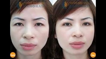 bấm mí bác sĩ mai mạnh tuấn - Thẩm mỹ viện Hà Nội