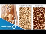 ¿Qué es la Osteoporosis? / Cómo prevenir la osteoporosis